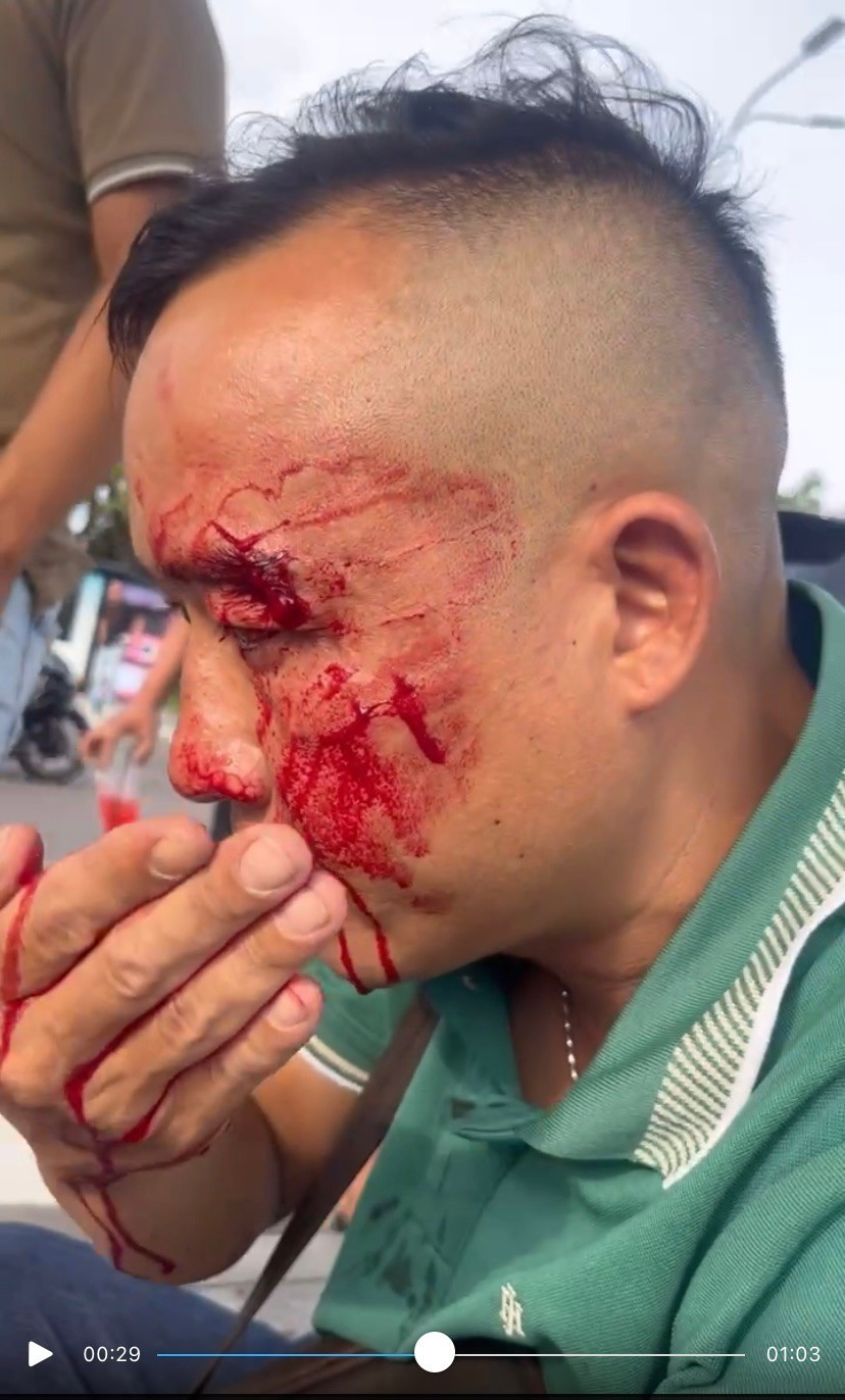 Ông Lộc bị nhóm thanh niên tấn công gây thương tích ở vùng mặt. Ảnh chụp từ clip 8.jpg